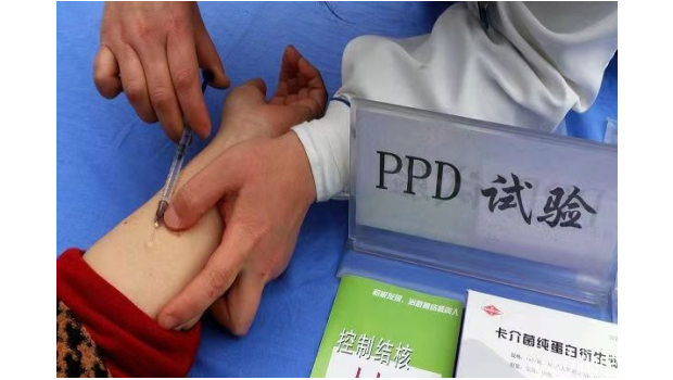 儿童做PPD试验后注意事项