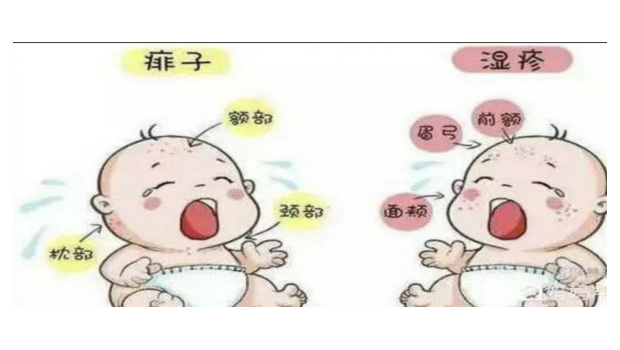 婴儿湿疹