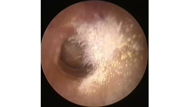 耳朵为啥痒？——耳真菌病