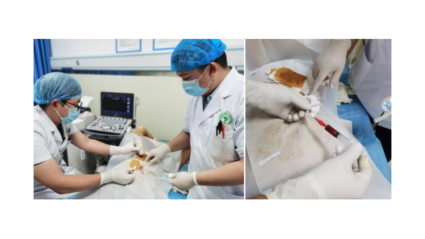 超声引导下PTCD术