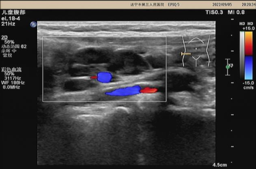 超声对小儿肠系膜淋巴结肿大的解读