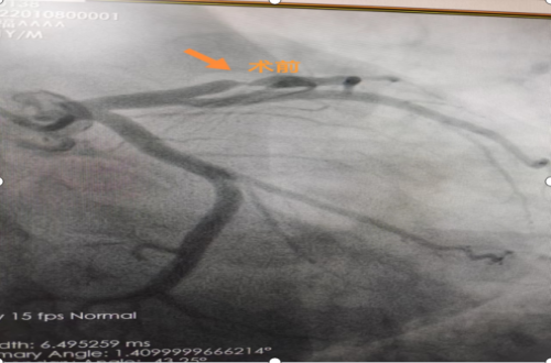 微创介入治疗，打通心脏血管“生命线”！